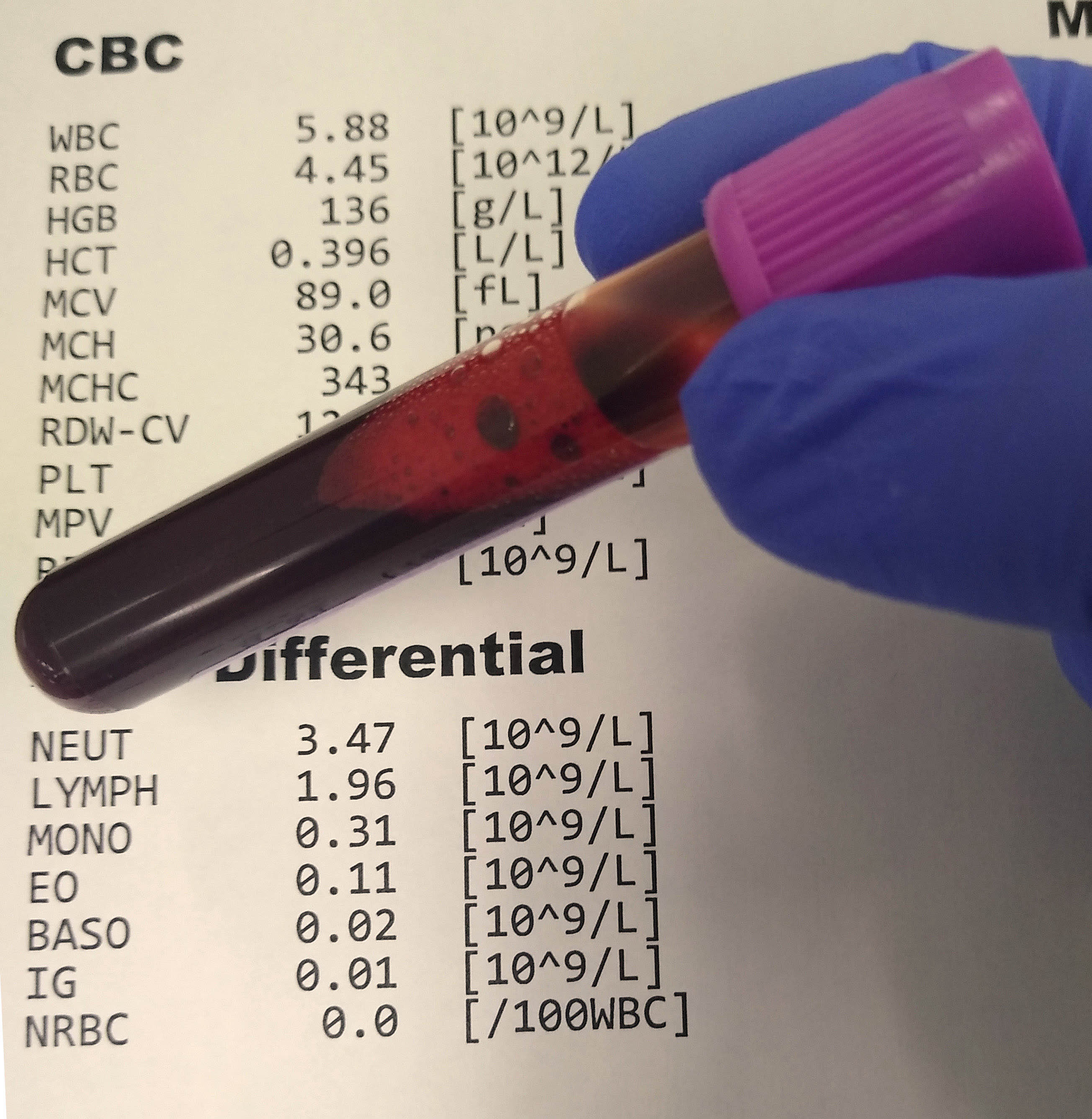 D-Dimer Test Guide: Normal Range, Cost & Results in India