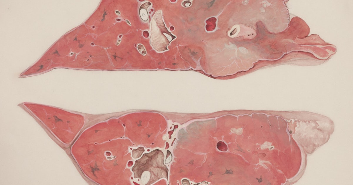Liver Cirrhosis in India: Causes, Tests & Treatment