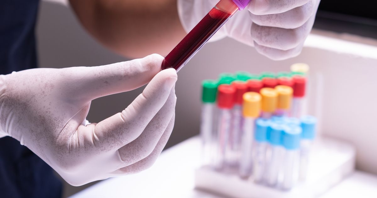 Prolactin Test: Normal Range & High Prolactin in India