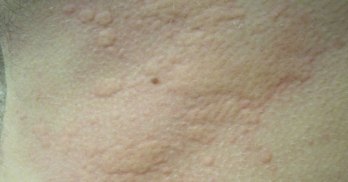Urticaria (Hives): Causes, Triggers & Management Guide