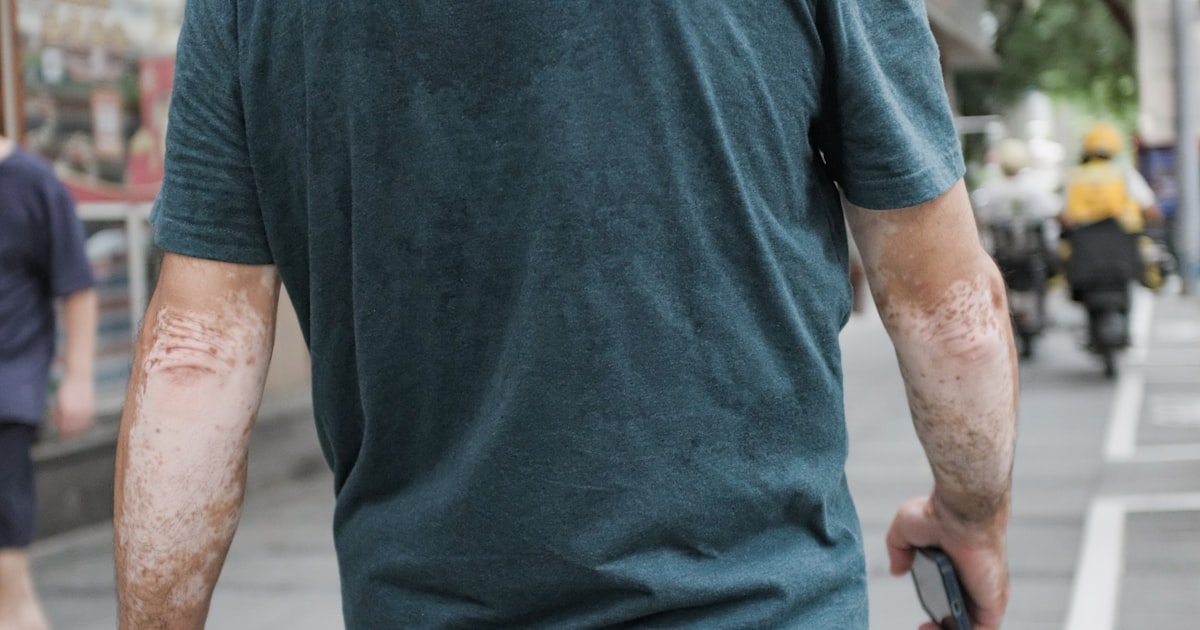 Vitiligo (Leucoderma) in India: Causes, Tests & Treatment